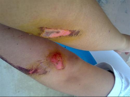 手臂擦伤图片,手臂擦伤急救与护理攻略