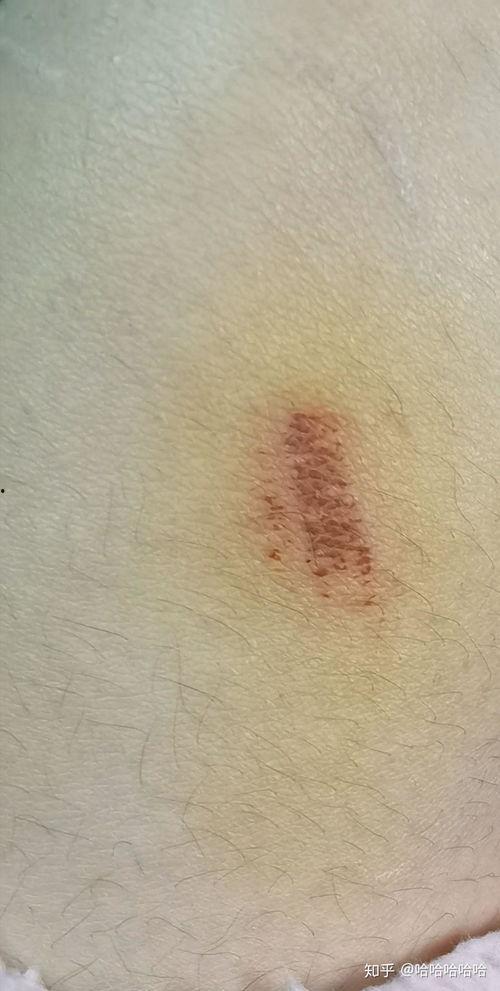 手臂擦伤图片,手臂擦伤急救与护理攻略